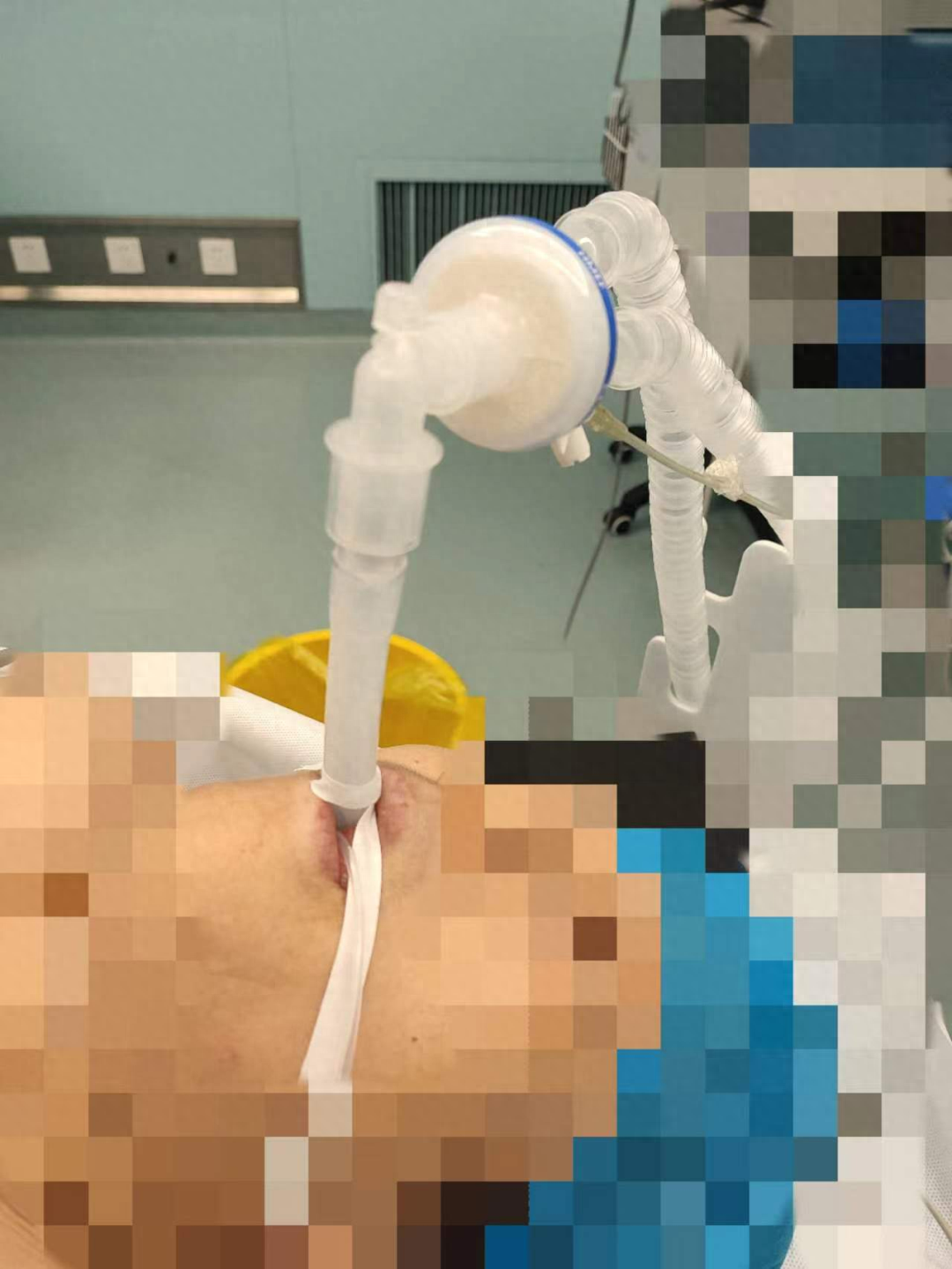 【一院技术】大手术 “小痛苦”——胸外科迈入"全面无管化"微创手术新高地